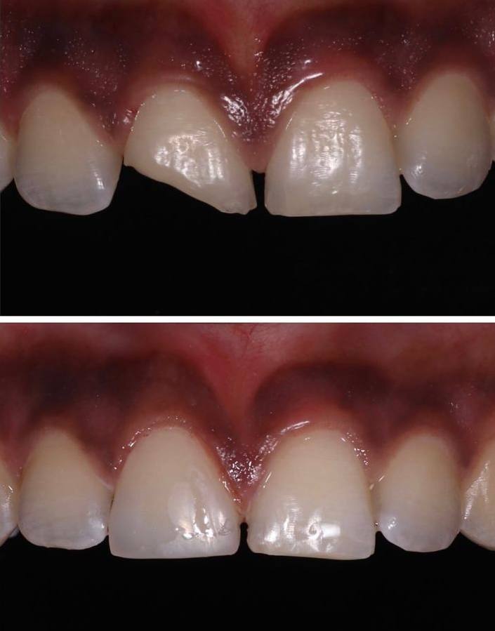 Antes y Después - Caso 1